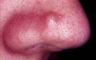 02bec8ca8d716e110ef66a26d18565d2 1 - Что значит гиперемирована слизистая носа: воспалённые слизистые носа и терапия, реструктуризация оболочек носа