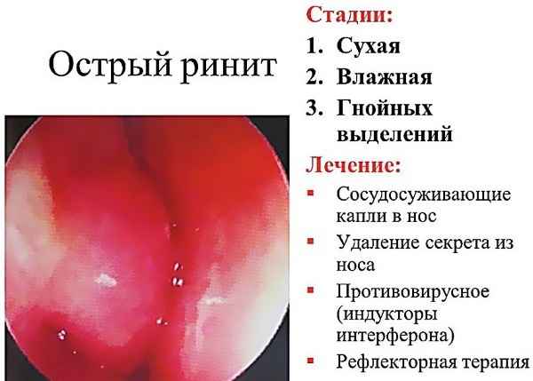 02c0a66fa800093ba6a70d4d4866b36f 1 - Золотистый стафилококк в носу у взрослых: симптомы и обследование, лечение, лечебные средства и профилактика