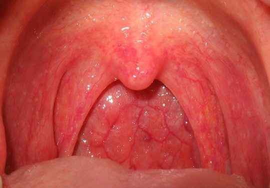 0330f9046066c9f01f7ad1fff7f4edb2 1 - Миндалины: как выглядят здоровые миндалины в горле, воспаление миндалин, лечение горла