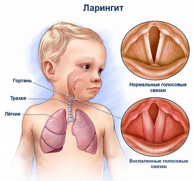 0593f1063a8091a739893095fbf5dfe8 1 - Ларинготрахеит: причины развития, симптомы и лечение трахеита и ларингита, как лечить трахеоларингит у детей
