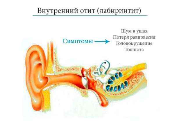 0898d9a132b43fd7ce6817e636888335 1 - Что такое отит: воспаление среднего уха, симптомы, виды и лечение
