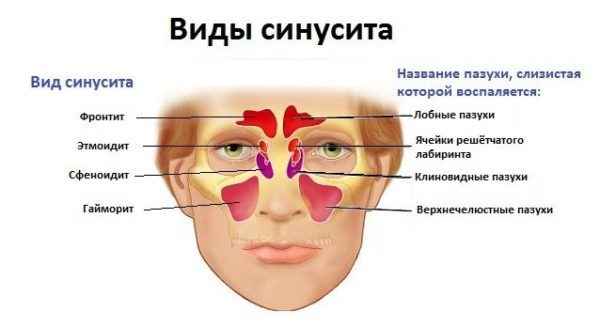 0baee544832a92c99516a17f757090fd 1 - Особенности лечения синусита: причины и симптомы,чем лечить синусит у взрослых
