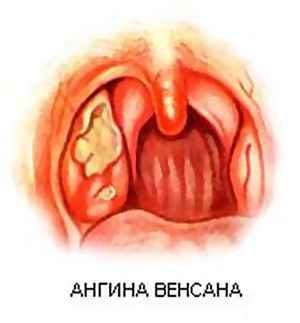 0bb91952931fa83b41b19ee6c490dfae 1 - Ангина симановского-венсана: причины развития язвенно-пленчатой ангины, лечение ангины плаута-венсана