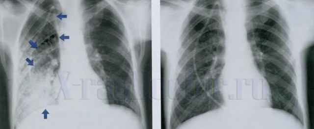 1011f89497151181972f5c031d147d60 1 - Пневмония на рентгеновских снимках: различия признаков для разных форм болезни на рентгене и фото