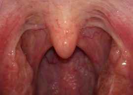 12b11fad226356003560825abc200347 1 - Миндалины в горле: основные причины, симптомы и лечение воспаления глоточных и небесных миндалин