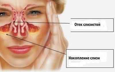 142883404778cff34a59446a09b4e2d4 1 - Прижигание слизистой носа лазером: возможные последствия процедуры по операции в носовых сосудах