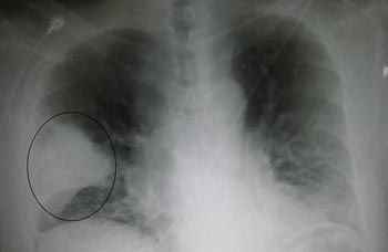 144e1cf9d7a615654d3f614810acc7db 1 - Плеврит лёгких: особенности, симптомы, а также лечение и профилактика воспаления