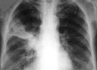 15cd906ad6a97809a59f4d9c317d8361 1 - Что такое инфильтрация лёгочной ткани: признаки и симптомы инфильтрата в лёгких