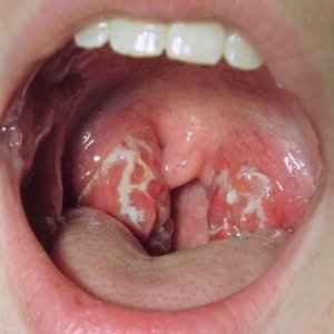 16d27ed924e9413a584d6d7b47604655 1 - Стафилококк золотистый ауреус — симптомы у взрослого и ребенка, фото в горле и зеве