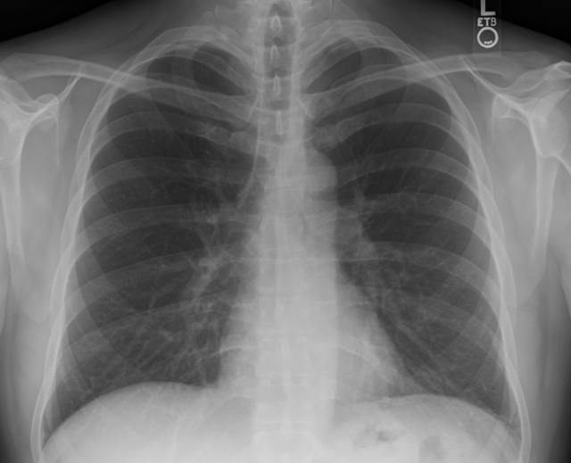 17a912043bd51fd1125c314d430013c1 1 - Пневмония на рентгеновских снимках: различия признаков для разных форм болезни на рентгене и фото