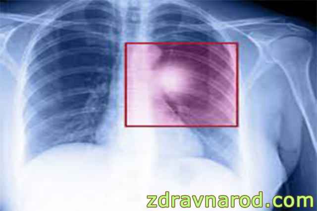 183a2bc570c6970cff553672e3de2b16 1 - Можно ли вылечить туберкулёз полностью? какими средствами следует лечиться