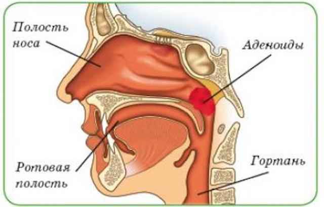 1a380ce3841ab6dd8bd15ce183acbd24 1 - Туботимпанальный отит среднего уха, симптомы и лечение