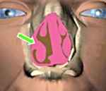 1c9995d98d74112ab62f168a1cf4218b 1 - Гипертрофия носовых раковин: что это такое, признаки конхобуллёза (утолщения слизистой оболочки)