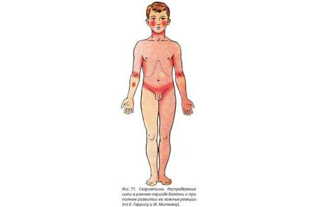 1d33166b72684b53ed3a934b955a7f08 1 - Особенности лечения скарлатины у ребенка: признаки и симптомы, формы, лечение