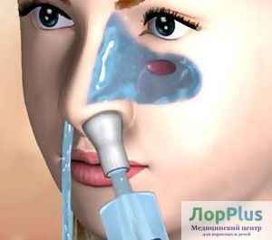 1e2b8d1d207574074ddfbe7e5236ed56 1 - Лор-процедура «кукушка», или методика промывания носа по проетцу