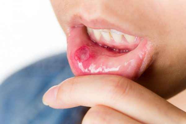 213a860ffb70f6e40202345a043c5add 1 - Гнойные язвочки во рту и причины их появления, а также виды болячек полости рта и их лечение