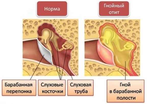 21cf0b1a2d2b98298f950418a99a0444 1 - Продувание слуховых труб по политцеру: что это такое, как проводится продувание ушей в стационаре и дома