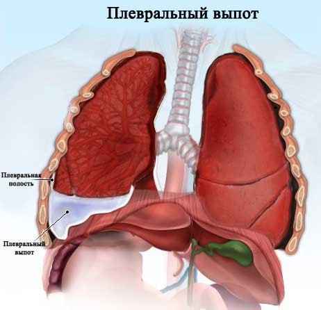 23d2da10083d84d520e4e75fd56fc669 1 - Плеврит лёгких: особенности, симптомы, а также лечение и профилактика воспаления