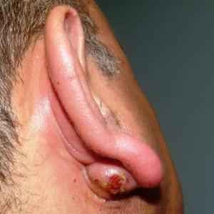 23ea1930acb1670945de7bfa1228cfa3 1 - Шарик на мочке уха: что это такое, причины образования такого уплотнения, почему болит такая шишка?