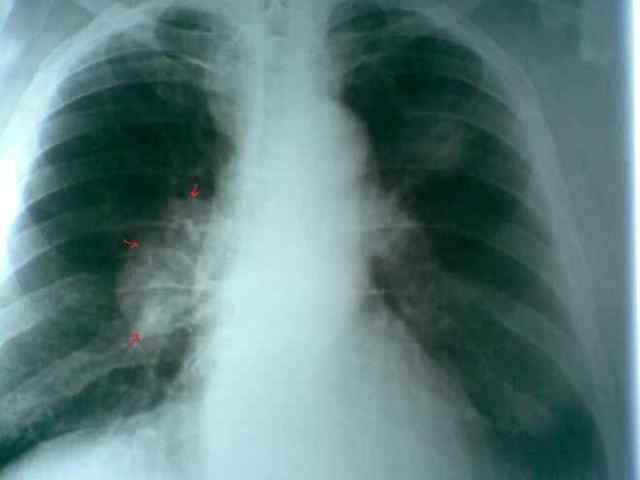 254a31e9d2e51a94585176d50db8b185 1 - Пневмония на рентгеновских снимках: различия признаков для разных форм болезни на рентгене и фото