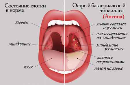 256d7ad6c41a7aa90fdd2214bb7ba337 1 - Растворы для полоскания горла у взрослых и детей при ангине