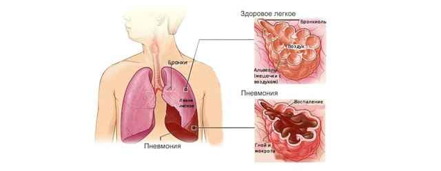 25dc839fca81753b6832776c21d9a471 1 - Воспаление легких: особенности заболевания, признаки и симптомы пневмонии