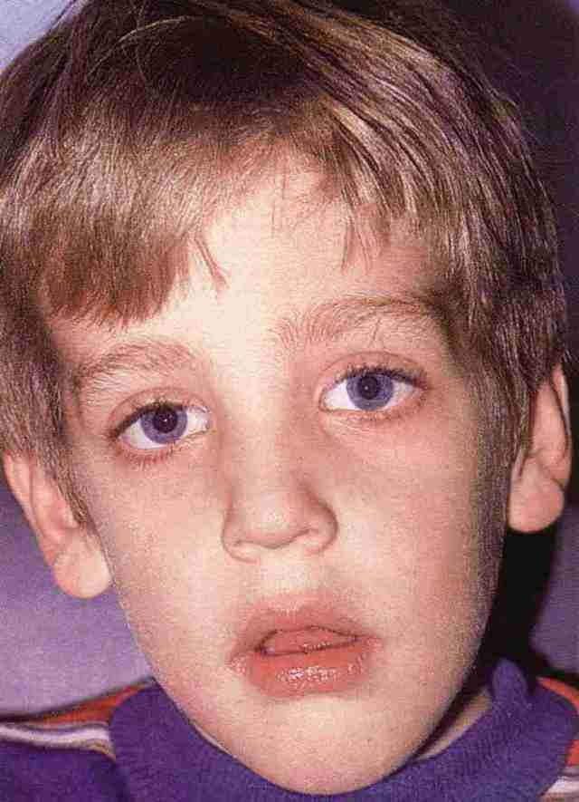 25ff3e75f6629ad3d9cc5bba4f154146 1 - Аденоидный тип лица у ребёнка, где находиться и как выглядит, фото