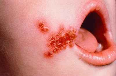 26dcf4a8c7d4a7c4f5e50743a1746d05 1 - Стафилококк во рту у взрослых и детей: причины появления и симптомы, фото и диагностика, способы лечения