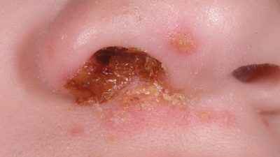 27278d2cb72545781773d03a11b1be9f 1 - Золотистый стафилококк в носу у взрослых: симптомы и обследование, лечение, лечебные средства и профилактика