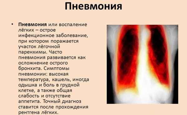 28d267a7c523922c614ea366c202f5fd 1 - Остаточный кашель после трахеита, как лечить трахеидный кашель