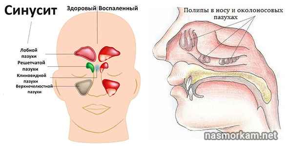 2940a480ec933d853df29d0367f3fa0f 1 - Симптомы воспаления слизистой оболочки носа: в чем заключается лечение