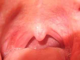 2a7e111122dc84b302e215487a6c532a 1 - Красное горло у ребенка: как определить болезнь и чем ее лечить
