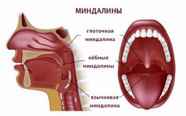 2cca2698d5f7557f1a3d723743158f54 1 - Миндалины в горле: основные причины, симптомы и лечение воспаления глоточных и небесных миндалин