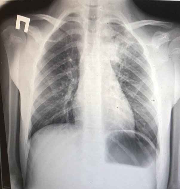 2cdfe2dd56a05fbfcf5a6b49909fecec 1 - Пневмония на рентгеновских снимках: различия признаков для разных форм болезни на рентгене и фото