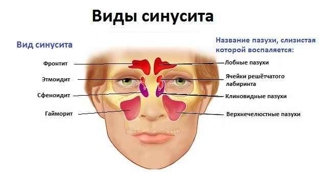 2f6a9ca551f63d7dc3e43fcc20a8e19f 1 - Заложенность носа и сильный насморк: чем вылечить, способы лечения в домашних условиях