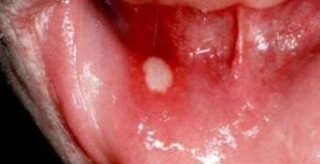 3068c165f1544426d2b46d267a3214af 1 - Гнойные язвочки во рту и причины их появления, а также виды болячек полости рта и их лечение