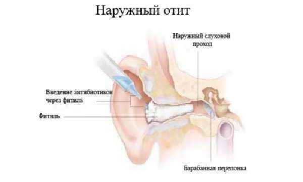 33033f1941dcd9ab5b6d3d26ef3f4190 1 - Как можно вылечить ухо: лечение болезней уха в домашних условиях