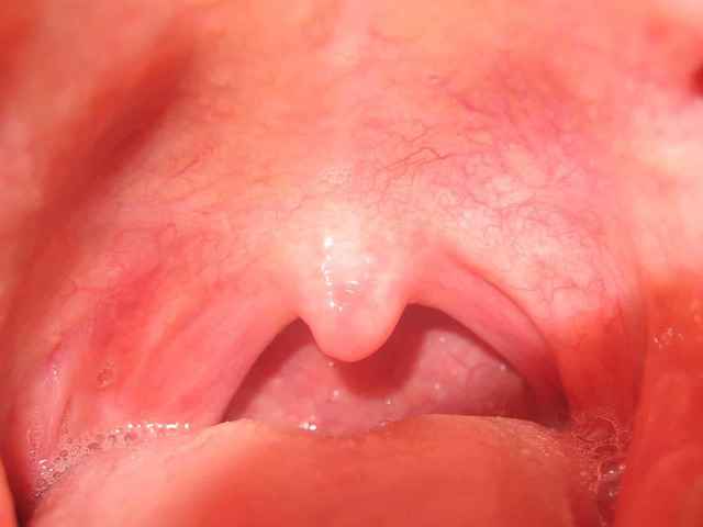 36a1146be24971d02fbca515101419c1 1 - Миндалины в горле: основные причины, симптомы и лечение воспаления глоточных и небесных миндалин