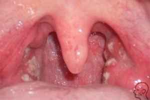 37548d1ec25adbb0b104d67a7bad5cb1 1 - Грибок в горле: причины развития заболевания, фото кандидоза гортани и лечение