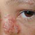 37d364ba7dd609805c4c379310b0d2c8 1 - Герпес в носу: симптомы заболевания, методы лечения, мази от герпеса