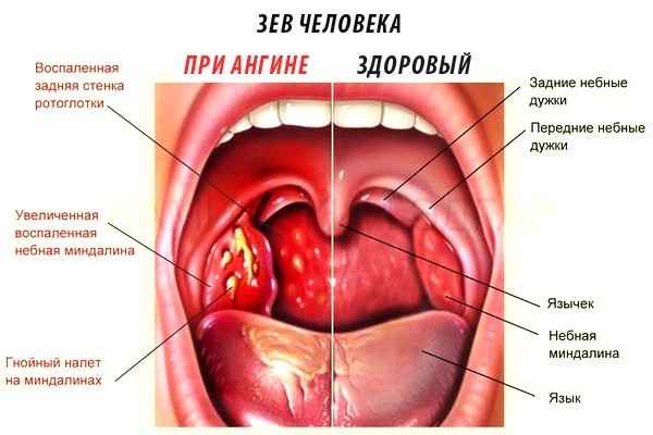 3a0c263196f0bb1407ebe8ea026f586c 1 - Ощущение кома в горле: отчего он может быть, как избавиться от комка при глотании, причины и способы лечения