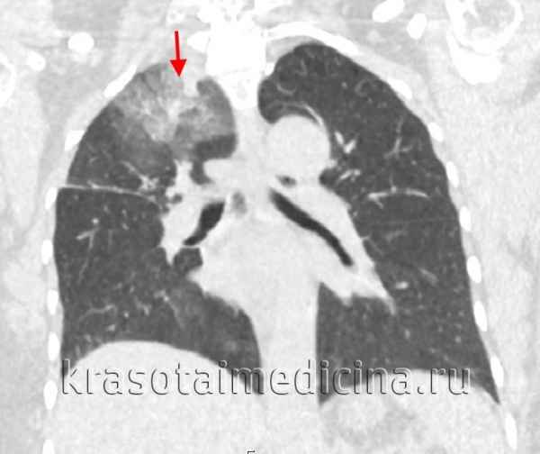 3be3644f4532faddd37390d0e97d61c7 1 - Что такое инфильтрация лёгочной ткани: признаки и симптомы инфильтрата в лёгких