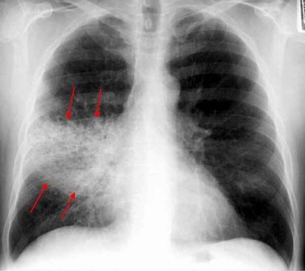 3cce9c87a13bde6be0bd9326a10612a7 1 - Пневмония на рентгеновских снимках: различия признаков для разных форм болезни на рентгене и фото