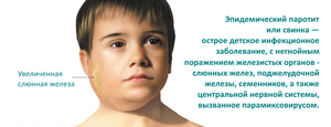 3f55c51d4e5ee12d0e74f6b1d4b89b77 1 - Основные характеристики эпид или вирусного паротита, его симптомы, осложнения и методы лечения у детей