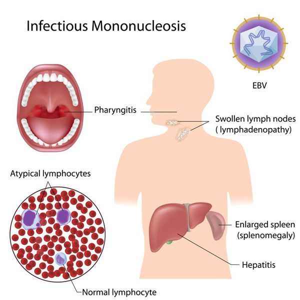 3f56c7b182957a235f0c6e9a42d3e218 1 - Инфекционный мононуклеоз (нуклеоз): симптомы у взрослых и детей, лечение