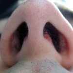 434a7d470f597b22ff11ecb975746d71 1 - Фурункул в носу: причины появления и симптомы фурункулеза, фото, как лечить чирей