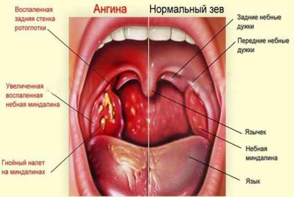 458b9c1766f38c237b27e577ef06d8e9 1 - Стафилококк во рту у взрослых и детей: причины появления и симптомы, фото и диагностика, способы лечения