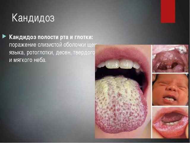 46498c74e9308d2be13703dbcb2bae80 1 - Грибковый тонзиллит: причины, симптомы, фото тонзилломикоза и лечение грибковой ангины у ребенка
