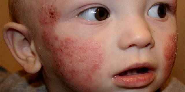 48ee50f47b457cc076732803f4053d21 1 - Герпесная инфекция у детей: симптомы и последствия заражения