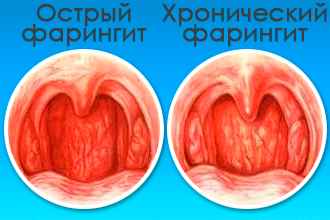48f5e1c3d4cca5eec779875939507aae 1 - Фарингит острый и хронический: симптомы и признаки воспаления глотки, лечение болезни горла